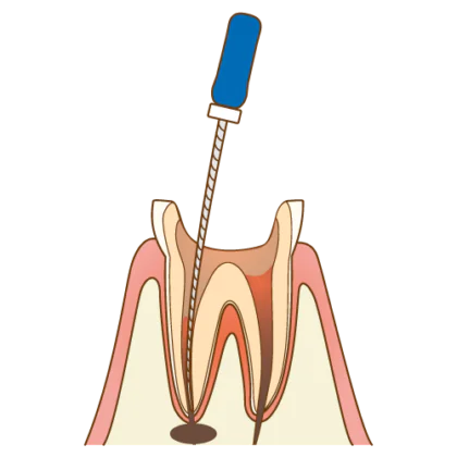根尖病巣の治療