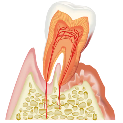 歯周病