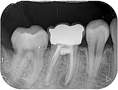 Case04急性根尖性歯周炎_after