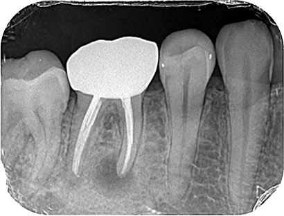 Case04急性根尖性歯周炎_before