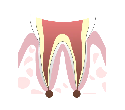 治療できていない根管が残っている