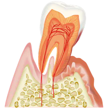 歯周病
